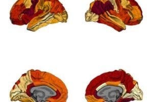 A comparison of cortical thickness between the brains of obese patients to those with Alzheimer’s disease. Darker colours indicate similarities in cortical thickness between the two groups.