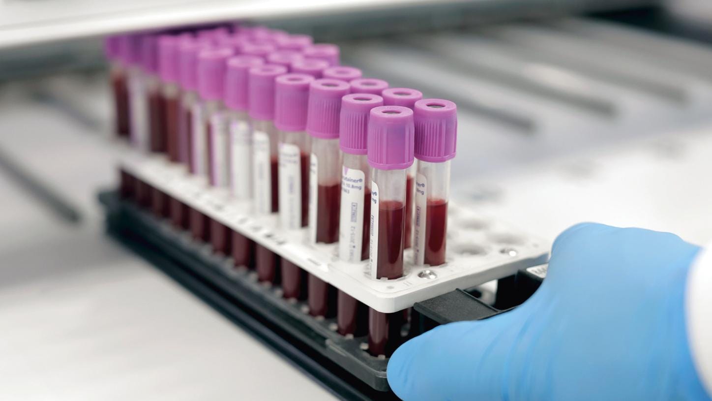 El papel de los biomarcadores de pruebas de laboratorio en el diagnóstico,  la estratificación de riesgos y la supervisión de los pacientes de COVID-19