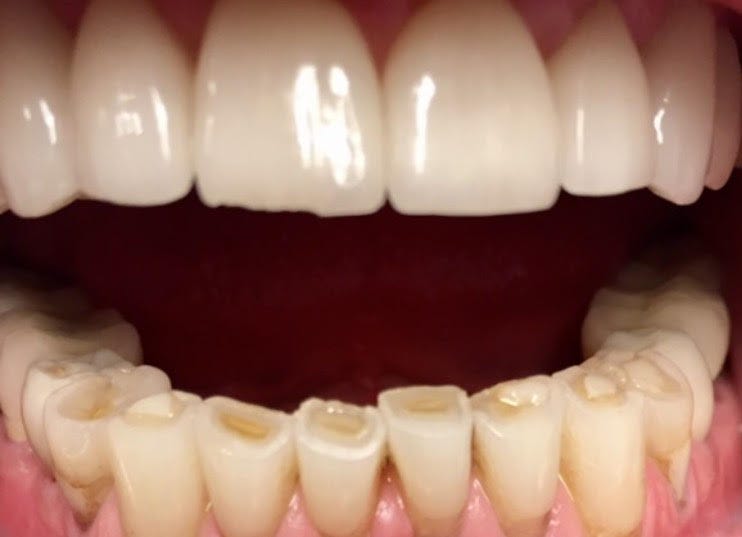 worn down teeth/grinding | Dr. Gentry