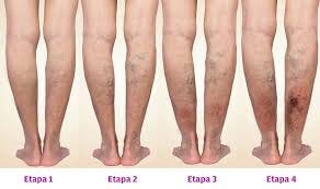 Vendaje de compresión en úlcera venosa