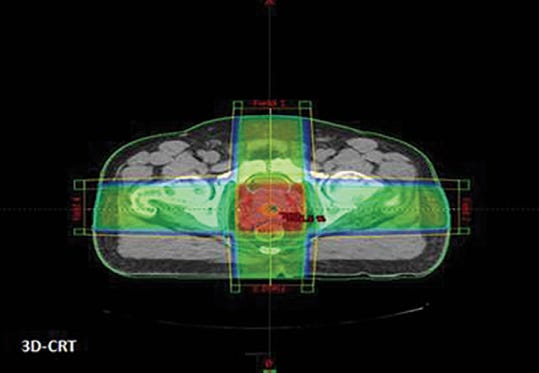 Image simply as a reminder that many of these older prostate trials are at least partially 3D. Four field box days. Protons101 Mark Storey MD