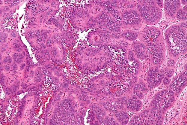Angiosarcoma image
