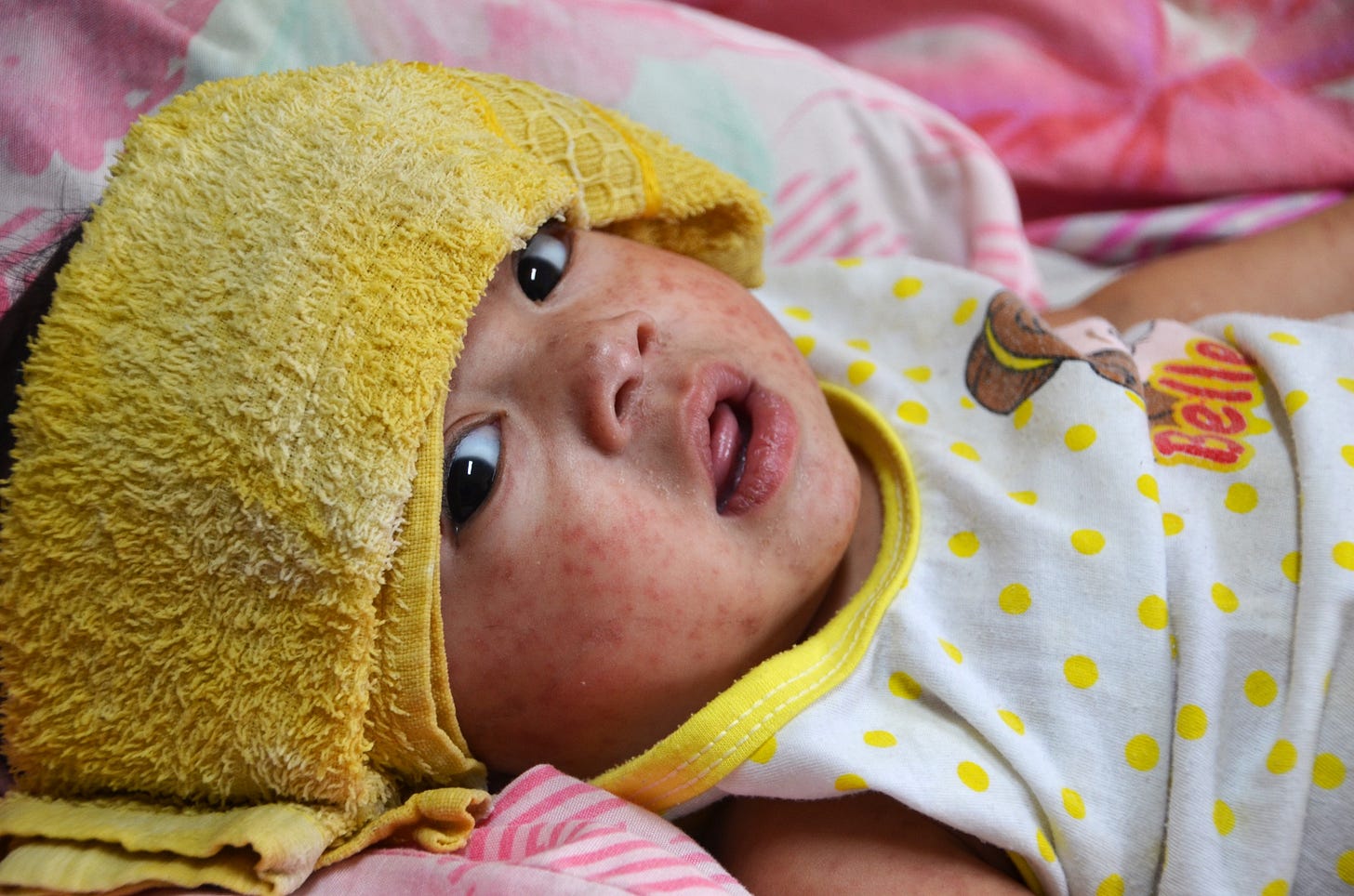 Measles isn’t a mild disease. Get vaccinated and protected and help #StopTheOutbreaks. 麻疹不是一种轻微的疾病。接种疫苗和保护并帮助 #StopTheOutbreaks。