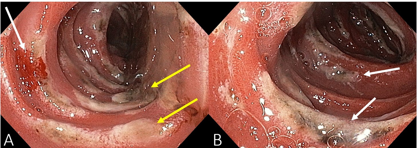 Zollinger-Ellison Syndrome