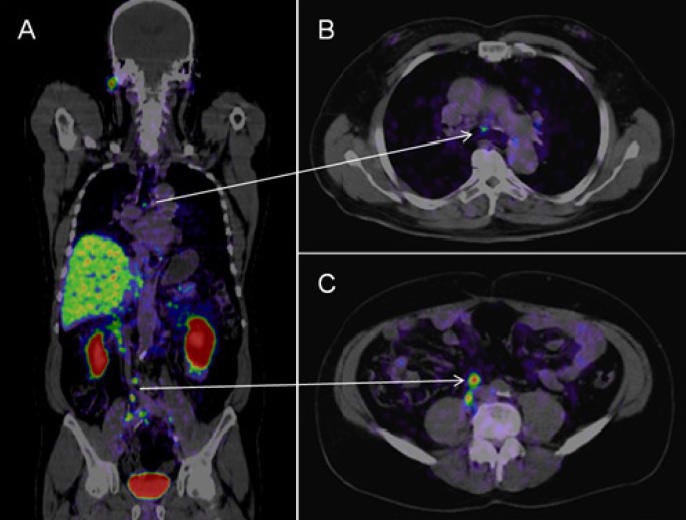 PSMA PET-CT Accurately Detects Prostate Cancer Spread - NCI