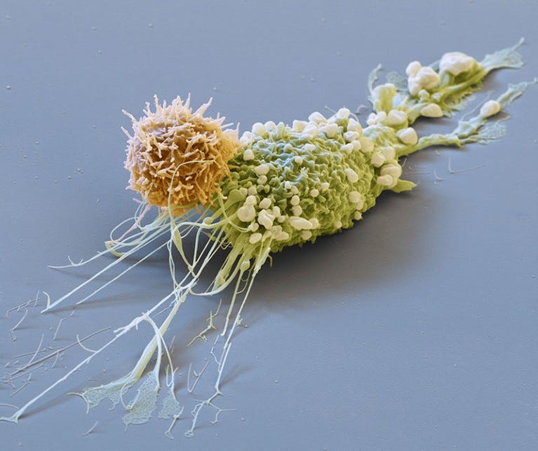 Coloured scanning electron micrograph of a breast cancer cell (green) being attacked by a chimeric antigen receptor T-cell (orange).