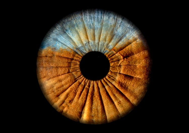 Heterochromatic iris photo