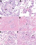 Histopathologic findings in a fatal case of multisystem inflammatory syndrome in adult after natural severe acute respiratory syndrome coronavirus 2 infection and coronavirus disease vaccination, Tennessee, USA, 2021. A) Lung tissue shows capillaritis characterized by neutrophilic inflammation and necrosis within interalveolar septa (arrowhead). Fibrin and organizing intraluminal microthrombi in small arteries are also seen (arrows). Original magnification 20×. B) Higher magnification of fibrin microthrombus within a lung vessel (arrow). Original magnification 63×. C) Heart tissue shows myocarditis with myocyte necrosis and mixed inflammatory infiltrate. Original magnification 20×. D) Higher magnification cardiac vessel showing microthrombus and perivascular mononuclear inflammatory infiltrate (arrow). Original magnification 40×. E) Stomach tissue shows submucosal microthrombi with perivascular lymphocytic infiltrate. Original magnification 63×. F) Kidney tissue shows multiple fibrin thrombi in glomerular (arrow) and interstitial capillaries (arrow). Original magnification 40×.
