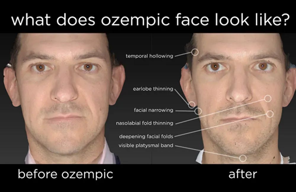 Ozempic for Weight Loss: What is Ozempic Face? | Top Newport Beach Plastic  Surgeon | Jonathan Zelken, MD | Jonathan Zelken, MD
