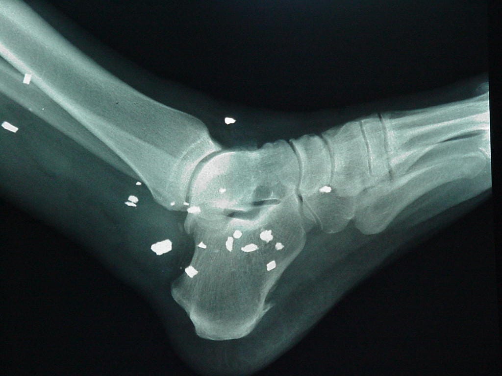 File:Korean War shrapnel ankle X-ray.jpg - Wikimedia Commons