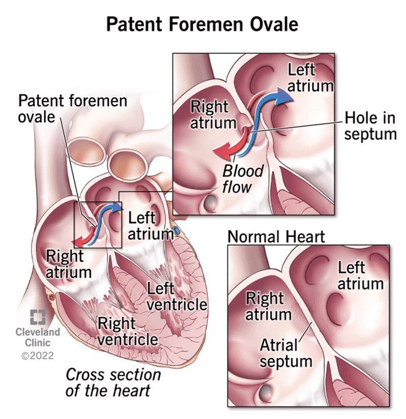 Patent Foramen Ovale (PFO): Symptoms, Causes & Treatment