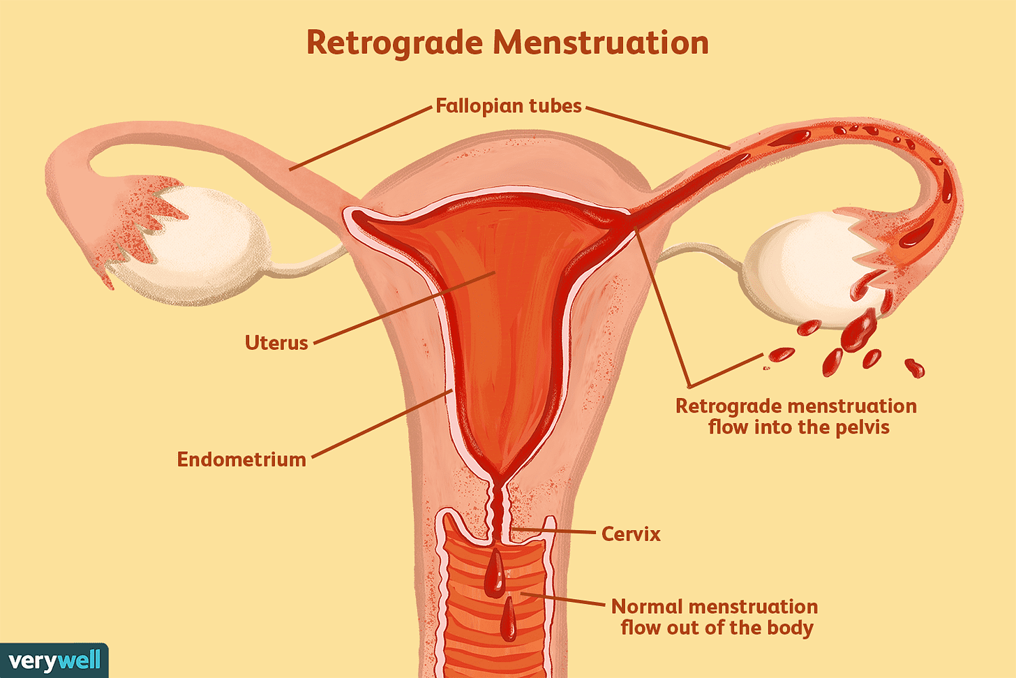 Retrograde Menstruation: Symptoms, Causes, Diagnosis