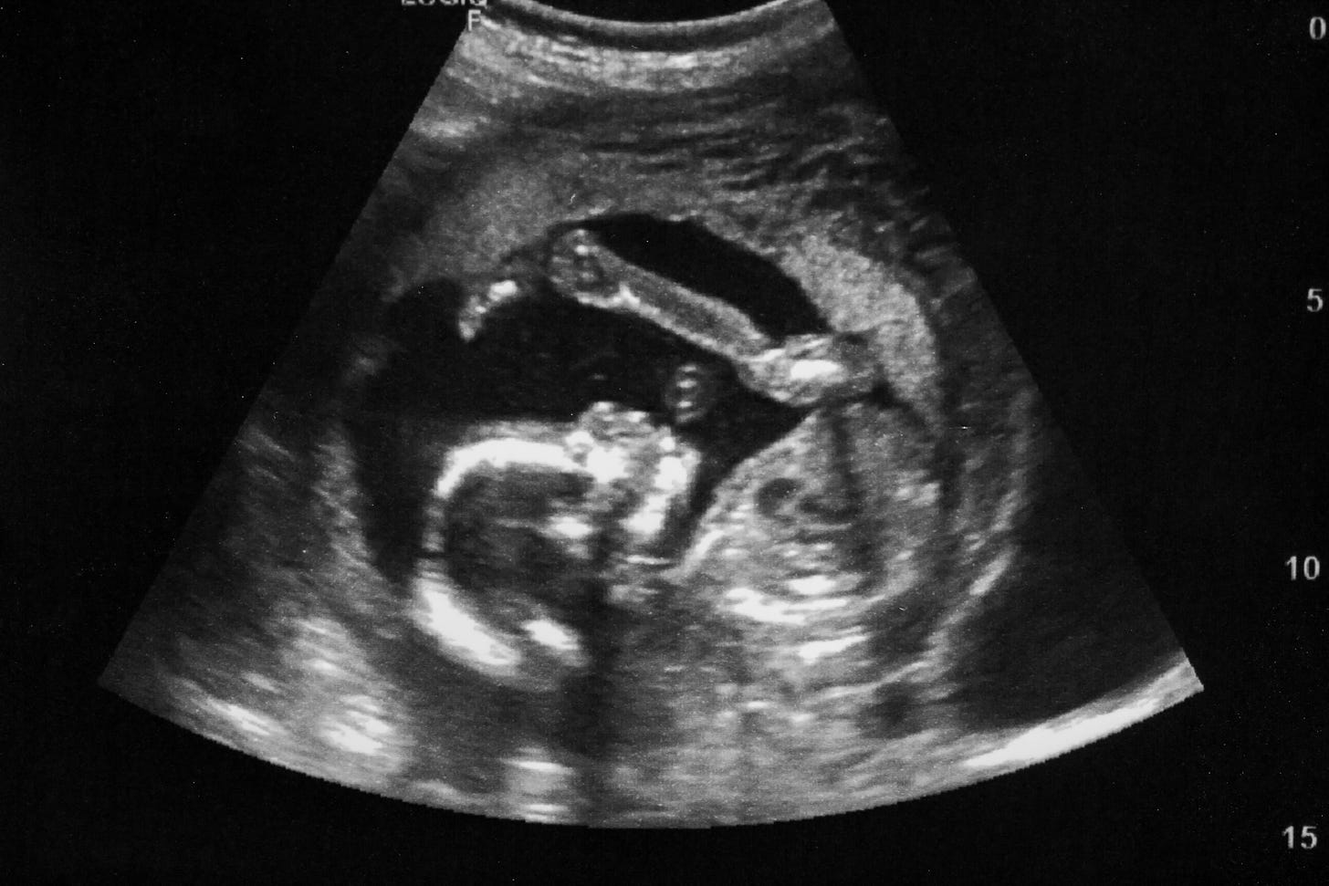 ultrasound of baby in the womb