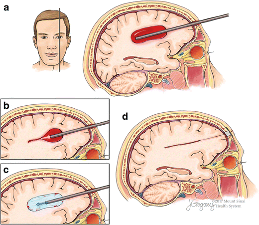 Minimally Invasive Surgery for Intracerebral Hemorrhage | Current Neurology  and Neuroscience Reports