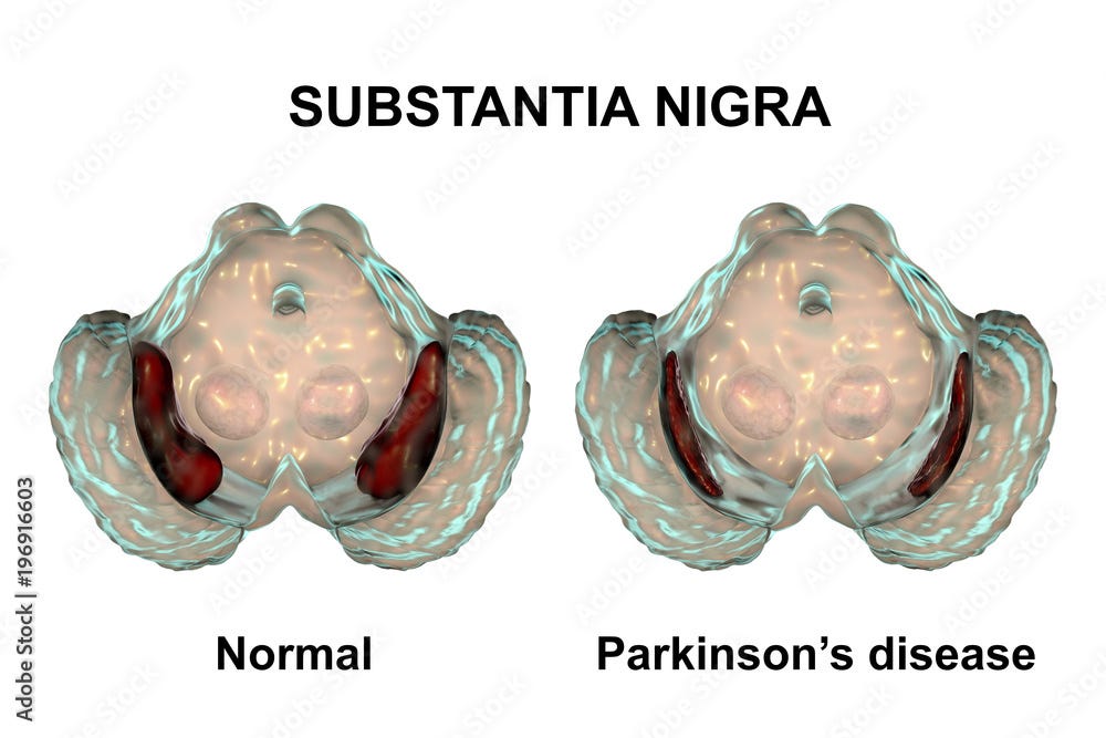Substantia nigra in norm and in Parkinson's disease, 3D illustration showing decrease of its volume. There is degeneration of dopaminergic neurons in the pars compacta of the substantia nigra