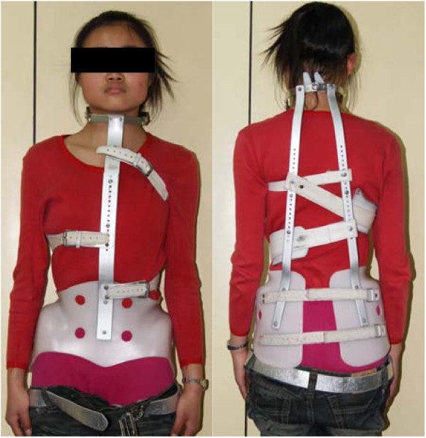 A young woman wearing a back brace A young woman wearing a back brace