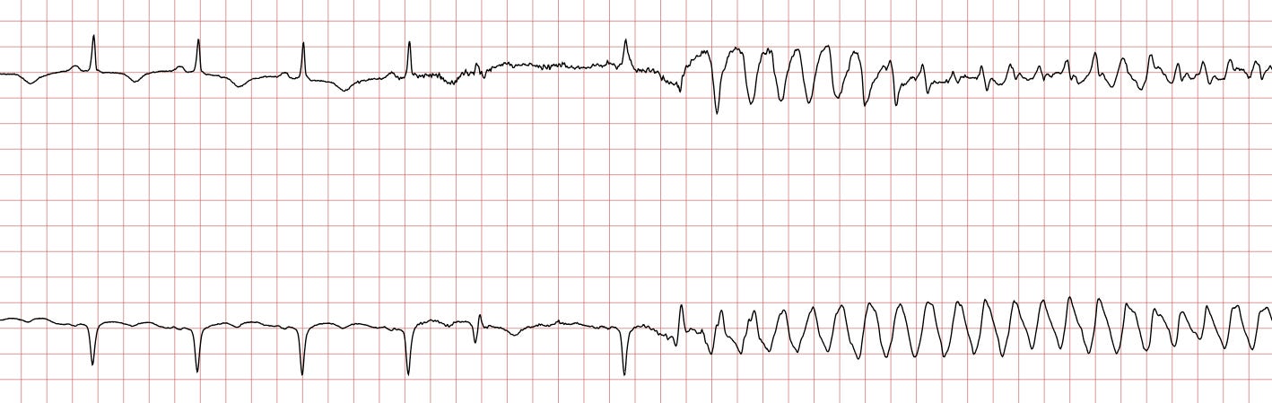Ventricular tachycardia (VT): ECG criteria, causes, classification, treatment – The Cardiovascular Ventricular tachycardia (VT): ECG criteria, causes, classification, treatment – The Cardiovascular