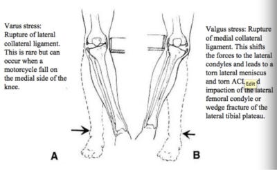 Valgus force often causes an ACL sprain