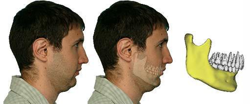 What is Jaw Surgery? | Los Angeles, CA | Jaw Surgery LA