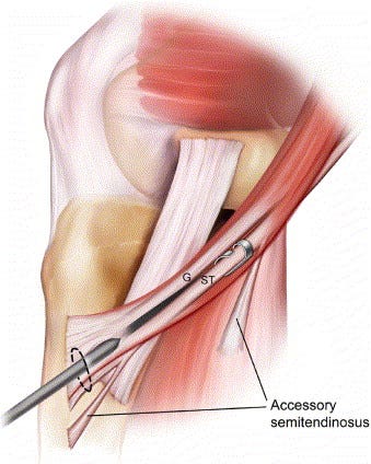 Complications Related to Hamstring Tendon Harvest - ScienceDirect