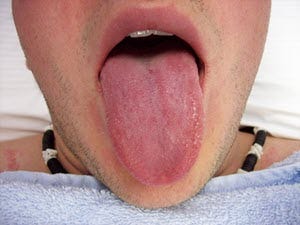 dry tongue