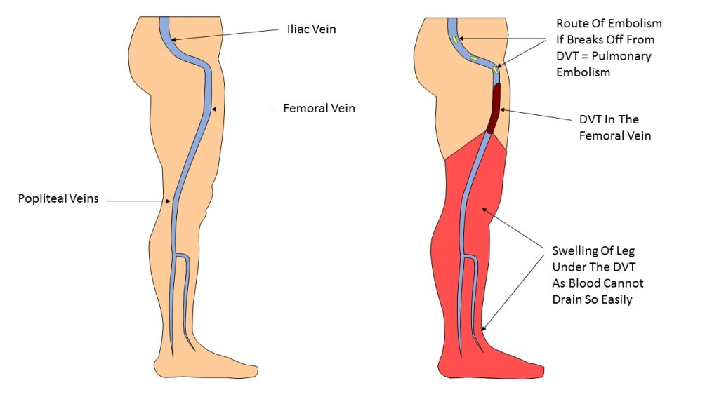 What you need to know about DVT | Dr Morton's - the medical helpline