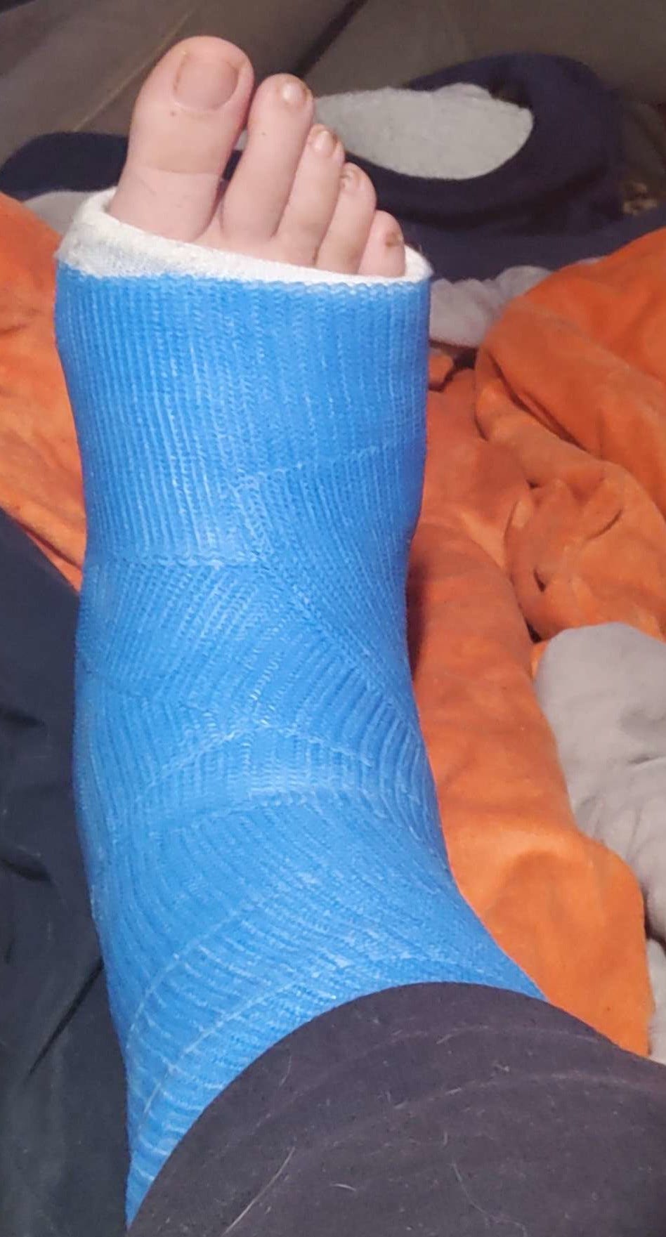 A picture showing a lower leg encased in a blue cast. The top is covered by trousers, and the toes stick out of the bottom.