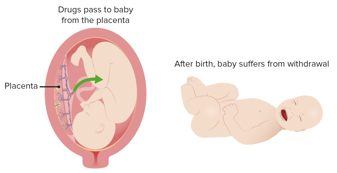 Neonatal Abstinence Syndrome | Concise Medical Knowledge