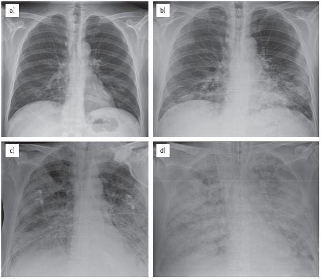 The above image pictures the lungs during 'white lung syndrome' or acute respiratory distress syndrome, which is diagnosed via the white spots or opaque areas appearing in the lungs. The above patient was a 57-year-old man in 2014