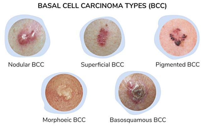 basal cell carcinoma types bcc