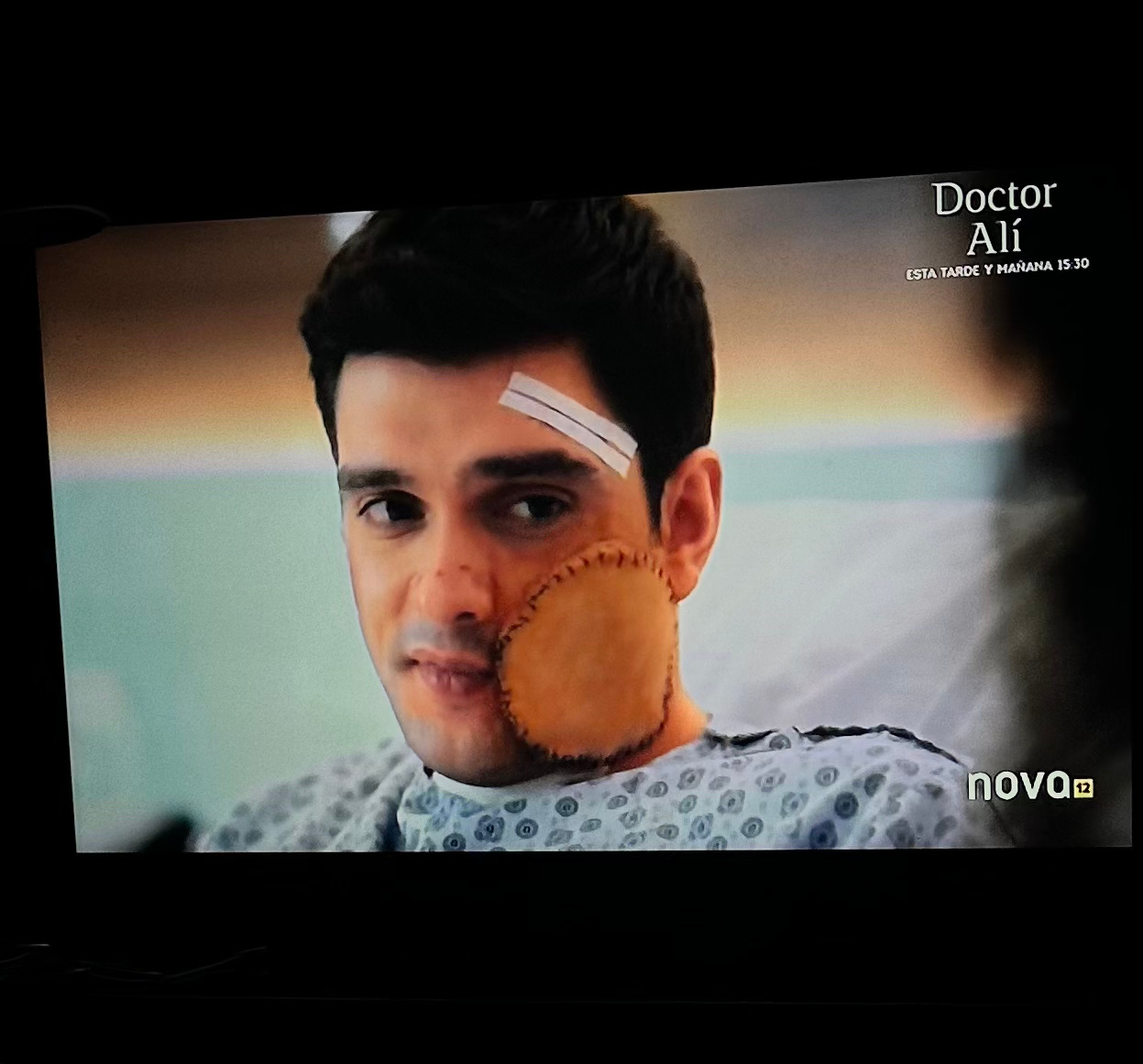 A screenshot of a Spanish telenovela in which a character has a large skin graft on his face.