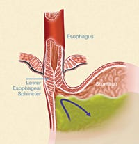 What is GERD | What is acid reflux | UCI Health | Orange County, CA