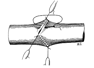 Alexis Carrel's own drawing of the triangulation method,.