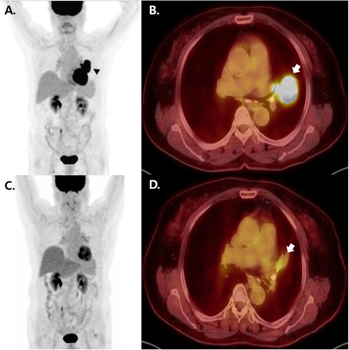 Spontaneous remission of advanced progressive poorly differentiated  non-small cell lung cancer: a case report and review of literature | BMC  Pulmonary Medicine | Full Text