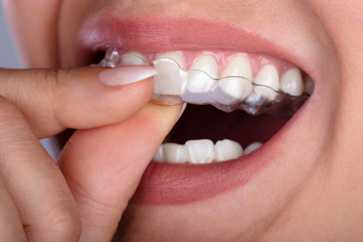 Clear Aligners in Las Vegas, NV | Centennial Family Dentistry