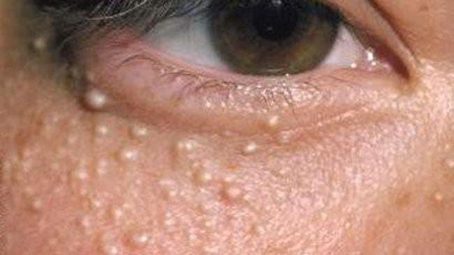 Milia Diagnosis and treatment Milia Diagnosis and treatment