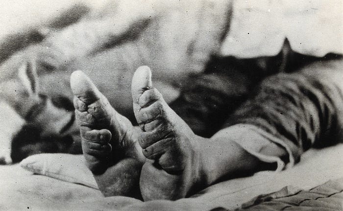 More details Feet of a Chinese woman, showing the effect of foot-binding
