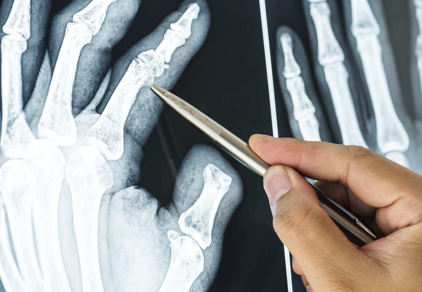 Psoriasi Reumatoide: Rimedi e Cure!