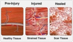 Scar Tissue and the Ways it Can Affect Your Body - Structura Body Therapies
