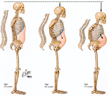 Itai Itai Disease