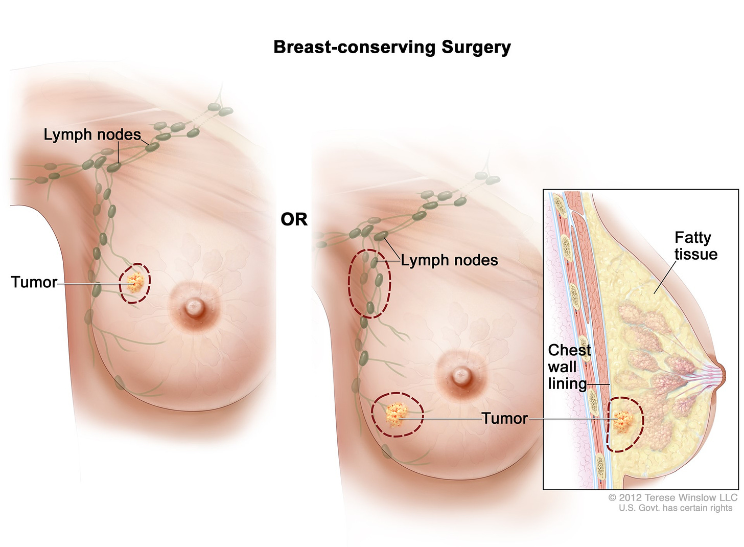 Breast-Conserving Surgery (Lumpectomy) | ACS