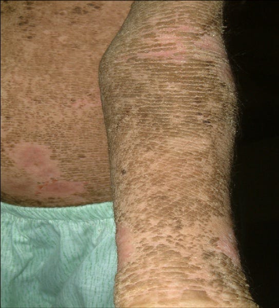 picture of a torso and arm with plaques associated with epidermolytic ichthyosis