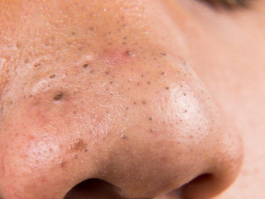 Tienes puntos negros o son filamentos sebáceos, ¿cuál es la diferencia? |  Salud180