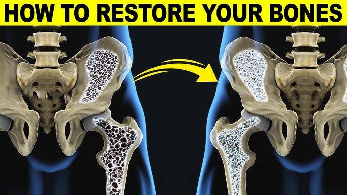 Best NEW Osteoporosis Treatments? [KoACT, Calcium, Vitamin D3 or K2?] -  YouTube