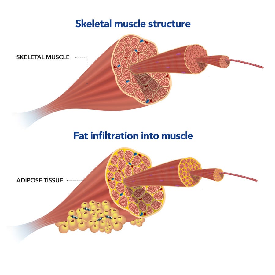 Co-existence of hepatosteatosis and skeletal muscle fat ...