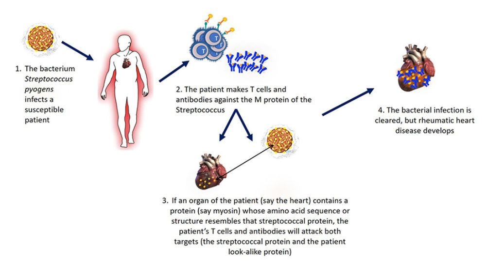Causes of Autoimmune Diseases - Autoimmune Disease | Johns Hopkins Pathology