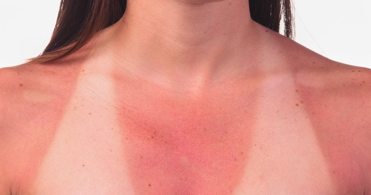 The Parts Of Your Body That Are Most Vulnerable To Getting Sun Damage |  HuffPost Life