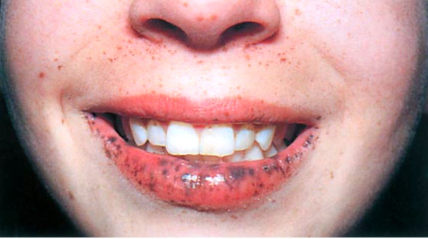Peutz Jeghers Syndrome