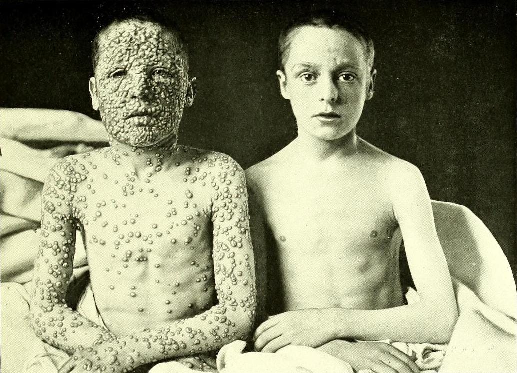 File:Allan Warner, photograph of two boys with smallpox (Atlas of Clinical  Medicine, Surgery, and Pathology, 1901) (cropped).jpg - Wikimedia Commons