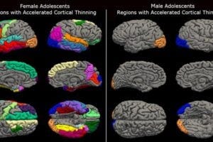 New research from the University of Washington’s Institute for Learning & Brain Sciences, or I-LABS, found the COVID-19 pandemic lockdowns resulted in unusually accelerated brain maturation in adolescents. This maturation was more pronounced in females, as seen on the left.